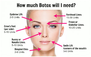 botox injection areas smile injected