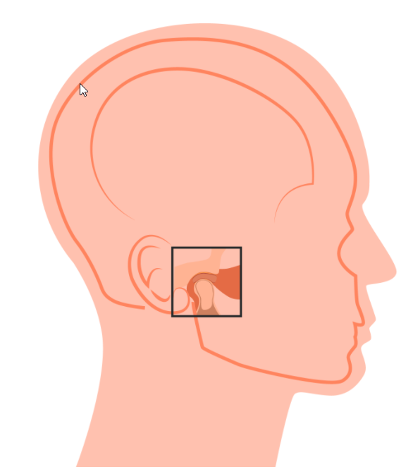Understanding Jaw Pain: TMJ Disorders, A diagram of TMJ disorder